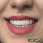 اصلاح طرح لبخند در تهران- شریعتی