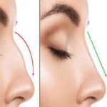 اصلاح فرم بینی بدون نیاز به جراحی با تزریق ژل