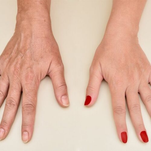 جوانسازی پوست دست ها با تزریق بوتاکس