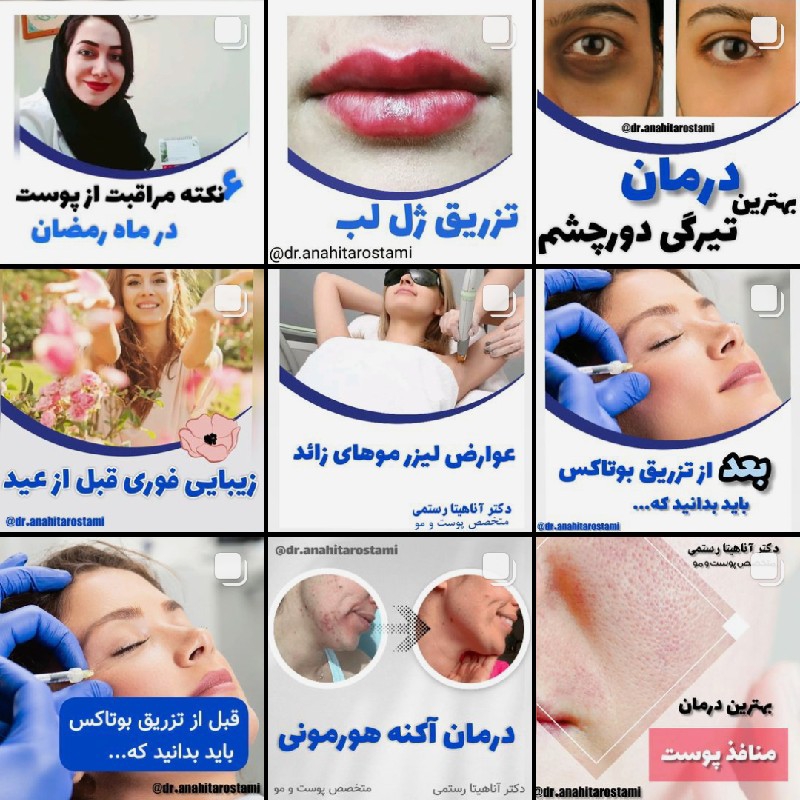 میکرودرم و مزوتراپی و پیل سطحی توسط متخصص پوست دکتر آناهیتا رستمی در طبس