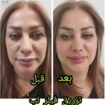 بوتاکس فیلر مزو تراپی کربوکسی مزو نیدلینگ مزو ژل تراپی